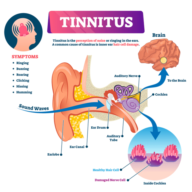 Tinitus